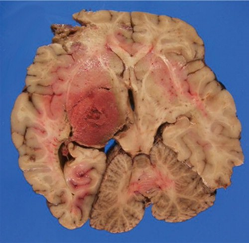മലിനജലം വഴി പകരുന്ന അപൂർവ്വ അമീബിയ രോഗം, സംസ്ഥാനത്ത് 15 കാരൻ മരിച്ചു