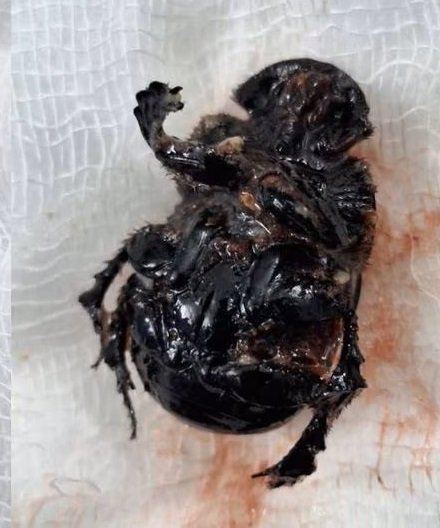 ശ്വാസ തടസ്സവുമായി എത്തിയ കുഞ്ഞിൻ്റെ തൊണ്ടയിൽ കെമ്പൻ ചെല്ലി വണ്ട്