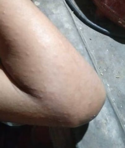 നൂറോളം വിദ്യാർഥികൾക്ക് ചൊറിച്ചിലും ശ്വാസതടസവും, സ്കൂൾ അടച്ചു